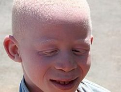 APA YANG PERLU DIPERHATIKAN AGAR SEORANG ALBINO HIDUP LEBIH SEHAT ?